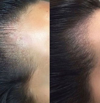 hairline microblading